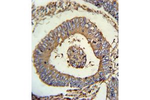 CALR Antibody (ABIN652259 and ABIN2841097) immunohistochemistry analysis in formalin fixed and paraffin embedded human colon carcinoma followed by peroxidase conjugation of the secondary antibody and DAB staining. (Calreticulin Antikörper)