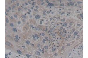 Detection of NTRK3 in Human Lung cancer Tissue using Polyclonal Antibody to Neurotrophic Tyrosine Kinase Receptor Type 3 (NTRK3) (NTRK3 Antikörper  (AA 32-429))