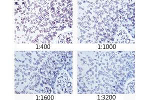 Immunohistochemistry of paraffin-embedded human esophageal cancer using Lamin A/C antibody (ABIN7268177) at dilution of 1:400 - 1:3200 (40x lens). (Lamin A/C Antikörper)