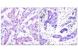 Immunohistochemical analysis of human paraffin-embedded human breast carcinoma tissue using ATF4 (Ab-245) antibody (E021053). (ATF4 Antikörper)