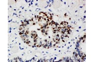 IHC-P: Nucleophosmin antibody testing of human intestinal cancer tissue (NPM1 Antikörper  (N-Term))