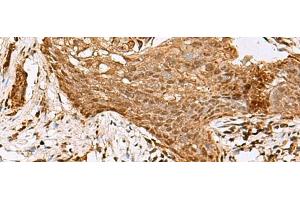 Immunohistochemistry of paraffin-embedded Human esophagus cancer tissue using SAMSN1 Polyclonal Antibody at dilution of 1:80(x200)