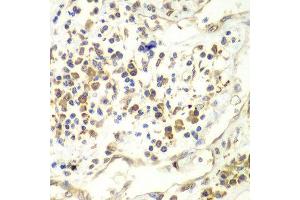 Immunohistochemistry of paraffin-embedded human liver cancer using UPF1 antibody at dilution of 1:100 (x40 lens). (RENT1/UPF1 Antikörper)