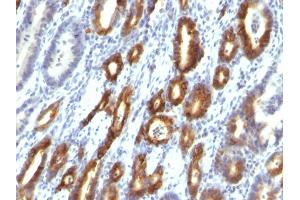 Formalin-fixed, paraffin-embedded human Gastric Carcinoma stained with MUC6 Monoclonal Antibody (MUC6/916). (MUC6 Antikörper)