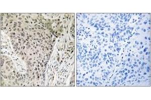 Immunohistochemistry analysis of paraffin-embedded human lung carcinoma, using ARHGEF19 Antibody. (ARHGEF19 Antikörper  (AA 251-300))