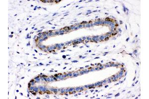 Anti- ASPH Picoband antibody,IHC(P) IHC(P): Human Mammary Cancer Tissue (Aspartate beta Hydroxylase Antikörper  (C-Term))