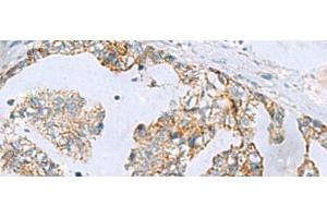 Immunohistochemistry of paraffin-embedded Human gastric cancer tissue using MGME1 Polyclonal Antibody at dilution of 1:70(x200) (C20orf72 Antikörper)