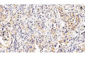 Detection of IL5Ra in Human Lung cancer Tissue using Polyclonal Antibody to Interleukin 5 Receptor Alpha (IL5Ra) (IL5RA Antikörper  (AA 42-182))