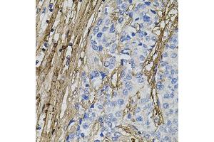 Immunohistochemistry of paraffin-embedded human prostate cancer using COL1A1 antibody.