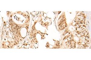 Immunohistochemistry of paraffin-embedded Human colorectal cancer tissue using ARID1B Polyclonal Antibody at dilution of 1:40(x200) (ARID1B Antikörper)