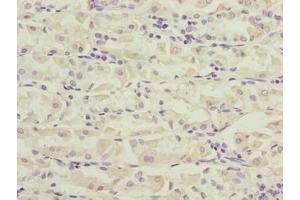 Immunohistochemistry of paraffin-embedded human gastric cancer using ABIN7162519 at dilution of 1:100 (PILRB Antikörper  (AA 20-191))