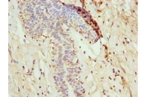 Immunohistochemistry of paraffin-embedded human breast cancer using ABIN7160728 at dilution of 1:100 (NANP Antikörper  (AA 1-248))