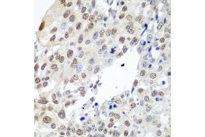 Immunohistochemistry of paraffin-embedded human lung cancer using PTTG1 antibody. (PTTG1 Antikörper)