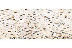 Immunohistochemistry of paraffin-embedded Human cervical cancer tissue using ABI2 Polyclonal Antibody at dilution of 1:45(x200) (ABI2 Antikörper)