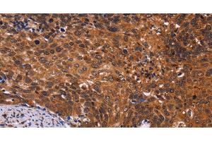 Immunohistochemistry of paraffin-embedded Human cervical cancer tissue using CDC5L Polyclonal Antibody at dilution 1:40 (CDC5L Antikörper)