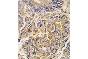 Formalin-fixed and paraffin-embedded human colon carcinoma tissue reacted with Autophagy G16L antibody , which was peroxidase-conjugated to the secondary antibody, followed by DAB staining. (ATG16L1 Antikörper  (AA 161-190))