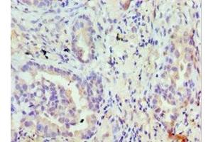Immunohistochemistry of paraffin-embedded human lung cancer using ABIN7172874 at dilution of 1:100 (TRPM8 Antikörper  (AA 980-1104))