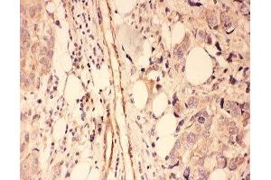 IHC-P: PSD-95 antibody testing of human breast cancer tissue