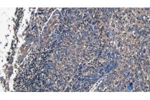 Detection of PECAM1 in Human Endometrial cancer Tissue using Polyclonal Antibody to Platelet/Endothelial Cell Adhesion Molecule (PECAM1) (CD31 Antikörper  (AA 199-287))