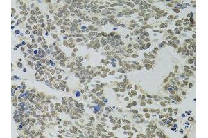 Immunohistochemistry of paraffin-embedded human lung cancer using PPP4C antibody. (PPP4C Antikörper  (AA 1-307))