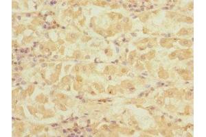 Immunohistochemistry of paraffin-embedded human gastric cancer using ABIN7149799 at dilution of 1:100 (DET1 Antikörper  (AA 15-240))