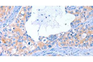 Immunohistochemistry of paraffin-embedded Human cervical cancer tissue using ARRB1 Polyclonal Antibody at dilution 1:50 (beta Arrestin 1 Antikörper)