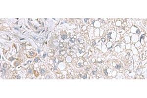 Immunohistochemistry of paraffin-embedded Human liver cancer tissue using STK32A Polyclonal Antibody at dilution of 1:95(x200)