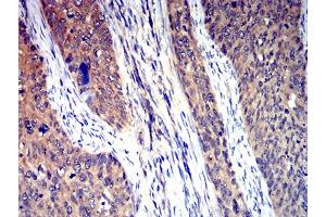 Immunohistochemical analysis of paraffin-embedded cervical cancer tissues using HTR3A mouse mAb with DAB staining. (Serotonin Receptor 3A Antikörper  (AA 24-157))