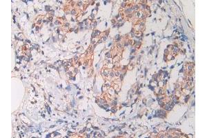 IHC-P analysis of Human Bile duct cancer Tissue, with DAB staining. (Cathelicidin Antikörper)