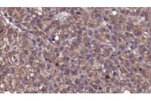 ABIN6276801 at 1/100 staining Human liver cancer tissue by IHC-P. (GRK2 Antikörper  (Internal Region))