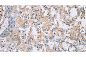Immunohistochemistry of paraffin-embedded Human thyroid cancer using CDCP1 Polyclonal Antibody at dilution of 1:50