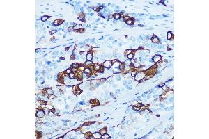 Immunohistochemistry of paraffin-embedded human esophageal cancer using Cytokeratin 5 (KRT5) (KRT5) Rabbit mAb (ABIN7268103) at dilution of 1:100 (40x lens). (Cytokeratin 5 Antikörper)