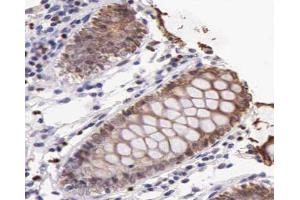 ABIN6266556 at 1/100 staining human colon carcinoma tissue sections by IHC-P.