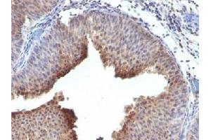 IHC testing of FFPE human bladder carcinoma and Cytokeratin 6 antibody. (Keratin 6 Antikörper  (C-Term))