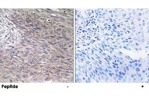 Immunohistochemistry analysis of paraffin-embedded human cervix carcinoma tissue using CHPF polyclonal antibody .