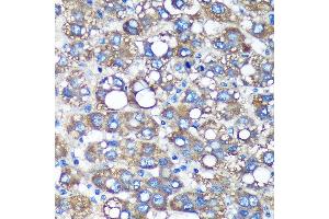 Immunohistochemistry of paraffin-embedded Human liver cancer using TIMMDC1 Rabbit pAb (ABIN7270929) at dilution of 1:100 (40x lens). (TIMMDC1 Antikörper  (AA 206-285))