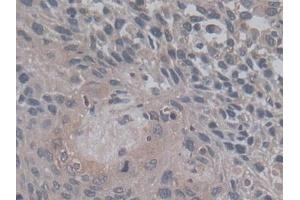 IHC-P analysis of Human Lung cancer Tissue, with DAB staining. (TGFB3 Antikörper  (AA 24-300))