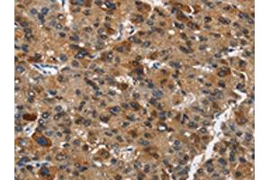 The image on the left is immunohistochemistry of paraffin-embedded Human liver cancer tissue using ABIN7190434(DCC Antibody) at dilution 1/70, on the right is treated with synthetic peptide. (DCC Antikörper)