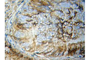 Immunohistochemistry of paraffin-embedded Breast cancer using STAT5B Antibody. (STAT5B Antikörper  (AA 40-280))
