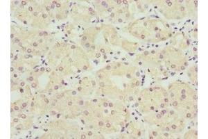 Immunohistochemistry of paraffin-embedded human gastric cancer using ABIN7149954 at dilution of 1:100 (FMO1 Antikörper  (AA 363-532))