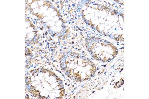 Immunohistochemistry of paraffin-embedded Human colon using MMP17 Rabbit pAb (ABIN3017219, ABIN3017220, ABIN3017221 and ABIN1680859) at dilution of 1:100 (40x lens). (MMP17 Antikörper)