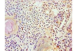 Immunohistochemistry of paraffin-embedded human breast cancer using ABIN7152570 at dilution of 1:100 (FUBP3 Antikörper  (AA 65-260))