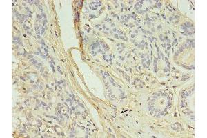 Immunohistochemistry of paraffin-embedded human breast cancer using ABIN7145079 at dilution of 1:100 (Aurora Kinase B Antikörper  (AA 1-255))