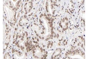 ABIN6279558 at 1/100 staining human Prostate carcinoma tissue sections by IHC-P. (Lysine (K)-Specific Methyltransferase 2B (KMT2B) (Internal Region) Antikörper)