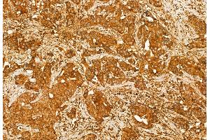 ABIN6260760 and ABIN6272939 at 1/100 staining Human breast cancer by IHC-P. (Centrin 1 Antikörper  (Internal Region))