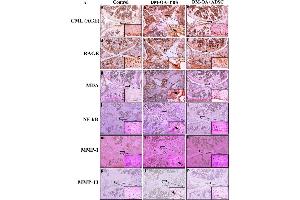 Immunohistochemistry (IHC) image for anti-Matrix Metallopeptidase 1 (Interstitial Collagenase) (MMP1) antibody (ABIN2854783)