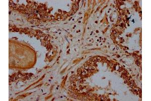 IHC image of ABIN7164923 diluted at 1:600 and staining in paraffin-embedded human prostate cancer performed on a Leica BondTM system. (PSME4 Antikörper  (AA 105-198))