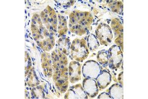 Immunohistochemistry of paraffin-embedded human colon carcinoma using APBB1 antibody (ABIN5971004) at dilution of 1/100 (40x lens).