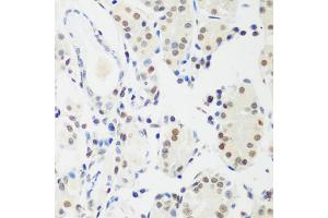 Immunohistochemistry of paraffin-embedded human gastric cancer using MECP2 antibody (ABIN5996064) at dilution of 1/100 (40x lens). (MECP2 Antikörper)