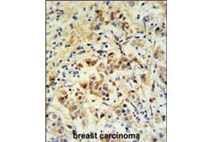 mouse BID Antibody (S61)IHC analysis in formalin fixed and paraffin embedded human breast carcinoma followed by peroxidase conjugation of the secondary antibody and DAB staining. (BID Antikörper  (AA 39-68))